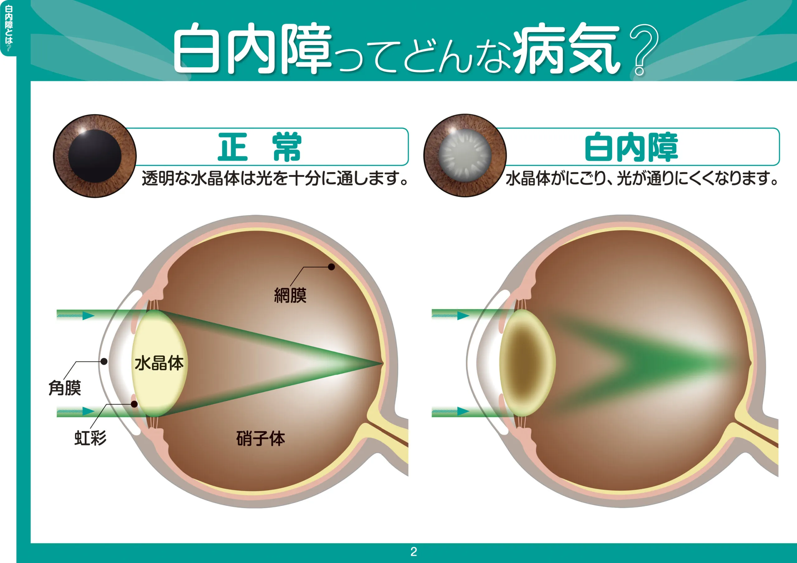白内障