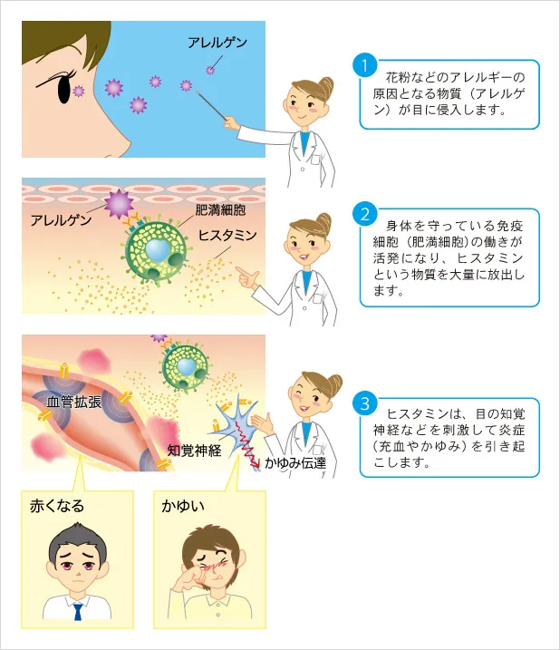 アレルギー性結膜炎