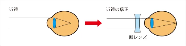 近視