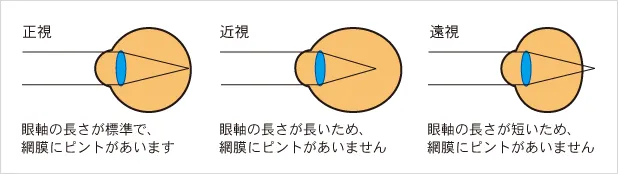 遠視