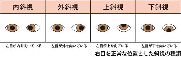 斜視